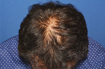 40代 男性 N.T.さん 前頭部・頭頂部 自毛植毛（MIRAI法）2,200株の症例（術後1年の経過）