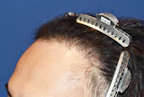 30代 男性 I.N.さん 生え際 自毛植毛（MIRAI法）800株の症例｜自毛植毛の症例（手術後）