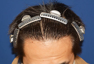 30代 男性 A.Y.さん 生え際 自毛植毛（MIRAI法）1,000株の症例（手術後）