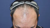 40代 男性 Y.K.さん 生え際・前頭部 自毛植毛（MIRAI法）3,000株の症例｜自毛植毛の症例（手術前）