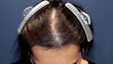 30代 男性 S.S.さん 生え際・前頭部・頭頂部 自毛植毛（MIRAI法）3,300株の症例｜自毛植毛の症例（手術後）