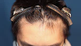 20代 男性 K.H.さん 生え際 自毛植毛（MIRAI法）700株の症例｜自毛植毛の症例（手術前）