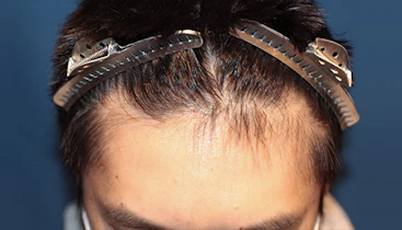 20代 男性 K.H.さん 生え際 自毛植毛（MIRAI法）700株の症例｜自毛植毛の症例（手術前）