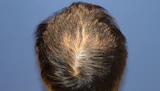 30代 男性  K.N.さん 頭頂部・つむじ（MIRAI法）1,300株の症例｜自毛植毛の症例（手術前）