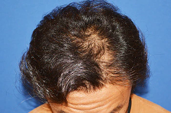 40代 男性 I.M.さん 生え際・頭頂部 自毛植毛（MIRAI法）1,500株（手術前の状態）