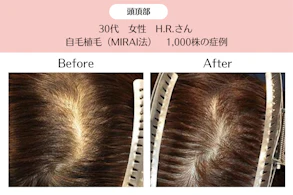 30代 女性 H.R.さん／頭頂部の自毛植毛(MIRAI法)／1,000株の症例