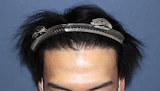 20代 男性  Y.B.さん 生え際・前頭部・頭頂部（MIRAI法）3,000株の症例｜自毛植毛の症例（手術前）