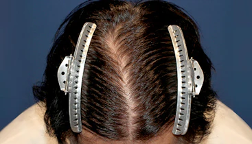 50代 男性 T.U.さん 前頭部 自毛植毛（MIRAI法）2,000株の症例｜自毛植毛の症例（手術後）