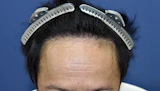 30代 男性 O.S.さん 生え際 自毛植毛（MIRAI法）1,500株の症例｜自毛植毛の症例（手術後）