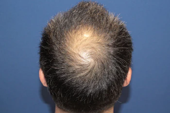 50代 男性 H.K.さん 生え際・頭頂部 自毛植毛（MIRAI法）2,000株の症例｜自毛植毛の症例（手術前）