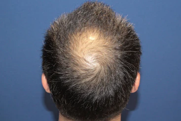 50代 男性 H.K.さん 頭頂部・つむじ 自毛植毛（MIRAI法）2,000株の症例｜自毛植毛の症例（手術前）