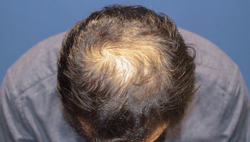 40代 男性 N.T.さん 前頭部・頭頂部 自毛植毛（MIRAI法）3,000株の症例｜自毛植毛の症例（1回目手術前）