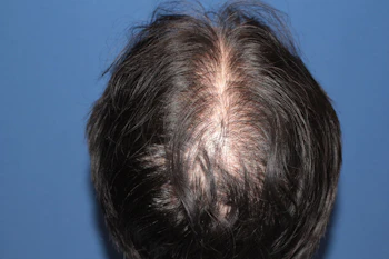 50代 男性 H.M.さん 生え際・前頭部・頭頂部 自毛植毛（MIRAI法）2,000株の症例｜自毛植毛の症例（手術1年後）