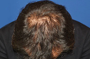 40代 男性 N.T.さん 前頭部・頭頂部 自毛植毛（MIRAI法）2,200株の症例（術後6ヶ月の経過）