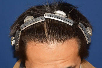 30代 男性 A.Y.さん 生え際 自毛植毛（MIRAI法）1,000株の症例（術後1年の経過）