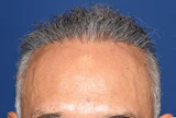 50代 男性 T.M.さん 生え際・前頭部 自毛植毛（MIRAI法）1,500株の症例｜自毛植毛の症例（手術後）