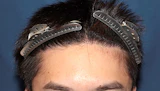 20代 男性 K.H.さん 生え際 自毛植毛（MIRAI法）700株の症例｜自毛植毛の症例（手術後）