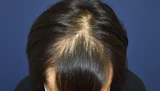 40代 男性 R.T.さん 生え際 自毛植毛（MIRAI法）1,000株の症例｜自毛植毛の症例（手術前）