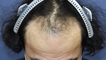 40代 男性  I.K.さん 生え際・前頭部 自毛植毛（MIRAI法）2,800株の症例｜自毛植毛の症例（手術前）