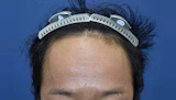 30代 男性 O.S.さん 生え際 自毛植毛（MIRAI法）1,500株の症例｜自毛植毛の症例（手術前）
