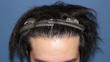 30代 男性 N.K.さん 生え際 自毛植毛（MIRAI法）1,200株の症例｜自毛植毛の症例（手術後）