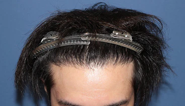 30代 男性 N.K.さん 生え際 自毛植毛（MIRAI法）1,200株の症例｜自毛植毛の症例（手術後）