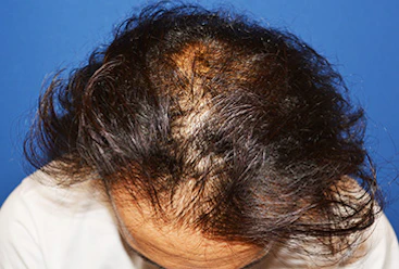 30代 男性 N.H.さん 生え際・頭頂部 自毛植毛（MIRAI法）2,000株の症例｜自毛植毛の症例（手術前）