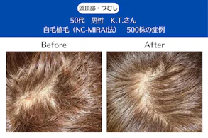 50代 男性 K.T.さん／頭頂部・つむじの自毛植毛(NC-MIRAI法)／500株の症例