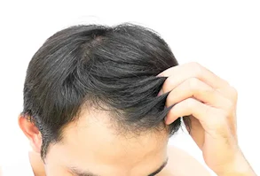 薄毛の悩みは植毛で解消できる？