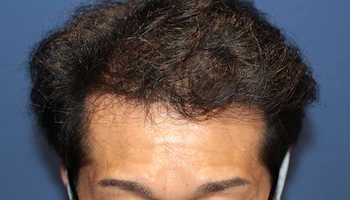 40代 男性 N.T.さん 生え際 自毛植毛（MIRAI法）3,000株の症例｜自毛植毛の症例（2回目手術から1年後）