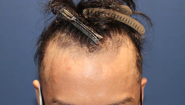 30代 男性 T.W.さん 生え際 自毛植毛（MIRAI法）1,700株の症例｜自毛植毛の症例（手術前）