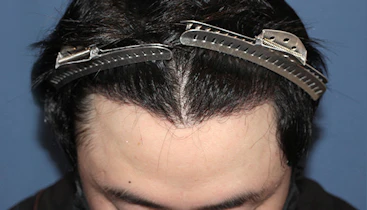 30代 男性 Y.Y.さん 生え際・つむじ 自毛植毛（MIRAI法）1,000株の症例｜自毛植毛の症例（手術後）