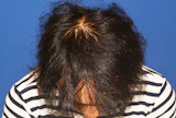 30代 男性 N.H.さん 生え際・頭頂部 自毛植毛（MIRAI法）2,000株の症例｜自毛植毛の症例（手術後）
