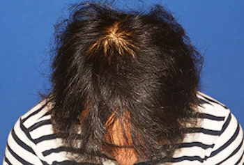 30代 男性 N.H.さん 生え際・頭頂部 自毛植毛（MIRAI法）2,000株の症例｜自毛植毛の症例（術後1年）