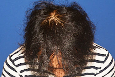 30代 男性 N.H.さん 生え際・頭頂部 自毛植毛（MIRAI法）2,000株の症例｜自毛植毛の症例（手術後）