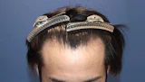 30代 男性 N.K.さん 生え際 自毛植毛（MIRAI法）1,200株の症例｜自毛植毛の症例（手術前）