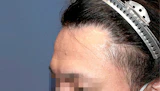 30代 男性 M.W.さん 生え際・瘢痕部 自毛植毛（MIRAI法）1,200株の症例｜自毛植毛の症例（手術後）
