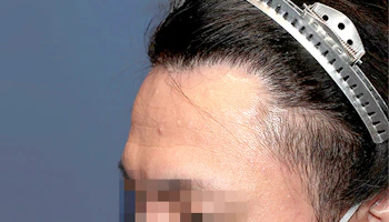 30代 男性 M.W.さん 生え際・瘢痕部 自毛植毛（MIRAI法）1,200株の症例｜自毛植毛の症例（手術1年後）