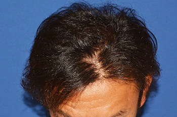 40代 男性 I.M.さん 生え際・頭頂部 自毛植毛（MIRAI法）1,500株（術後6ヶ月の経過）