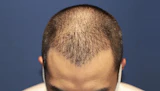 20代 男性 M.N.さん 生え際 前頭部 自毛植毛（MIRAI法）1,300株の症例｜自毛植毛の症例（手術後）