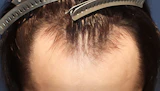 20代 男性 M.K.さん 生え際 自毛植毛（MIRAI法）1,500株の症例｜自毛植毛の症例（手術前）