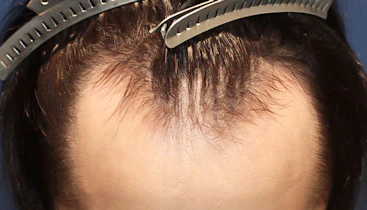 20代 男性 M.K.さん 生え際 自毛植毛（MIRAI法）1,500株の症例｜自毛植毛の症例（手術前）