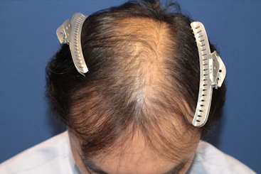 50代 男性 H.M.さん 生え際・前頭部・頭頂部 自毛植毛（MIRAI法）2,000株の症例｜自毛植毛の症例（手術前）
