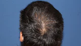 30代 男性  K.N.さん 頭頂部・つむじ（MIRAI法）1,300株の症例｜自毛植毛の症例（手術後）