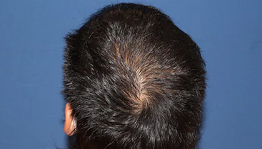 30代 男性  K.N.さん 頭頂部・つむじ（MIRAI法）1,300株の症例｜自毛植毛の症例（手術後）