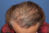 60代 男性 K.Y.さん 頭頂部 自毛植毛（MIRAI法）2,500株の症例｜自毛植毛の症例（手術後）