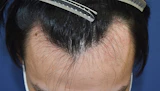 20代 男性 Y.U.さん 生え際 自毛植毛（MIRAI法）1,200株の症例｜自毛植毛の症例（手術前）