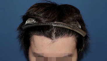 20代 男性 K.S.さん 前頭部 自毛植毛（MIRAI法）1,600株の症例｜自毛植毛の症例（手術後）