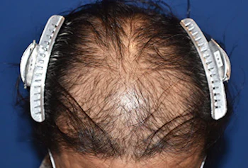 40代 男性 N.Y.さん 前頭部・頭頂部 自毛植毛（MIRAI法）2,000株の症例（手術前の状態）