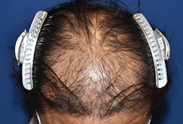 40代 男性 N.Y.さん 前頭部・頭頂部 自毛植毛（MIRAI法）2,000株の症例（手術前の状態）